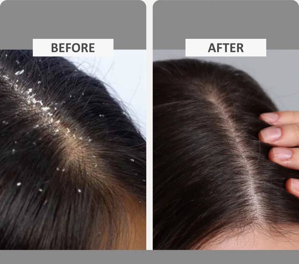 ANTI DANDRUFF SHAMPOO & CONDITIONER